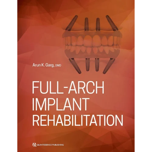 Full-Arch Implant Rehabilitation