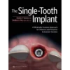 The Single-Tooth Implant