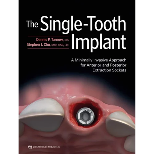 The Single-Tooth Implant