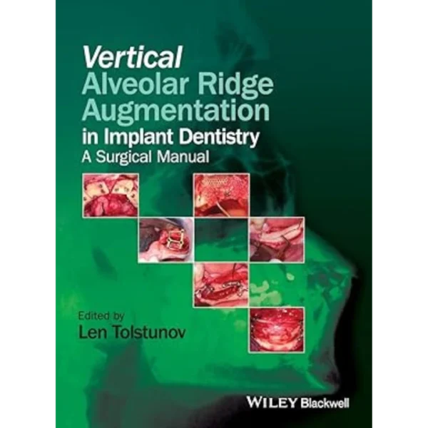 Vertical Alveolar Ridge Augmentation in Implant Dentistry Vertical Alveolar Ridge Augmentation in Implant Dentistry